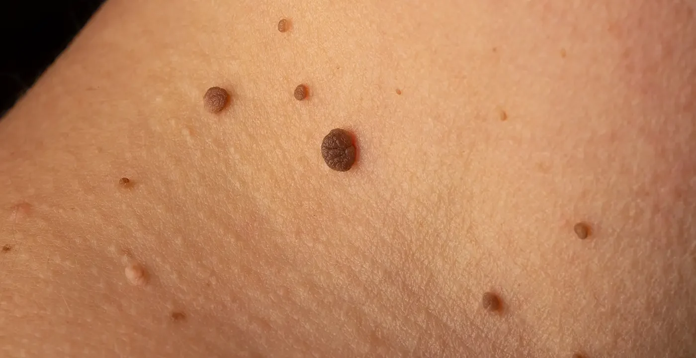 laser skin tag and mole removal
